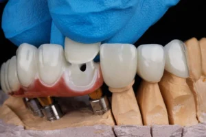 Dental-Crowns-And-Bridges