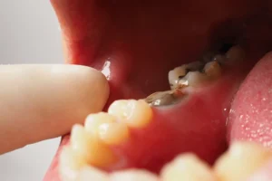 Root-Canal-Treatment (1)