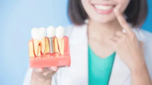 Dental Implants