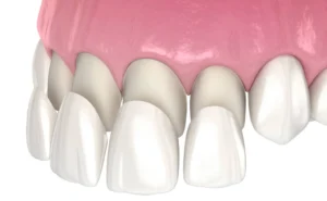 Dental-Veneers-1024x633