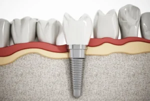 DentalImplants2-1000x675
