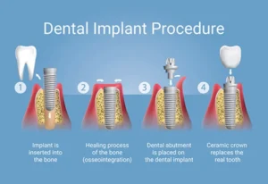 Implant-Example-Resized