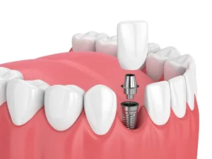 dorset-implants-1-1024x768
