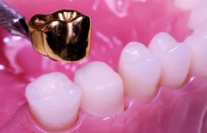 gold_dental_crown
