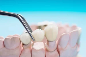 when-should-i-replace-my-dental-bridges